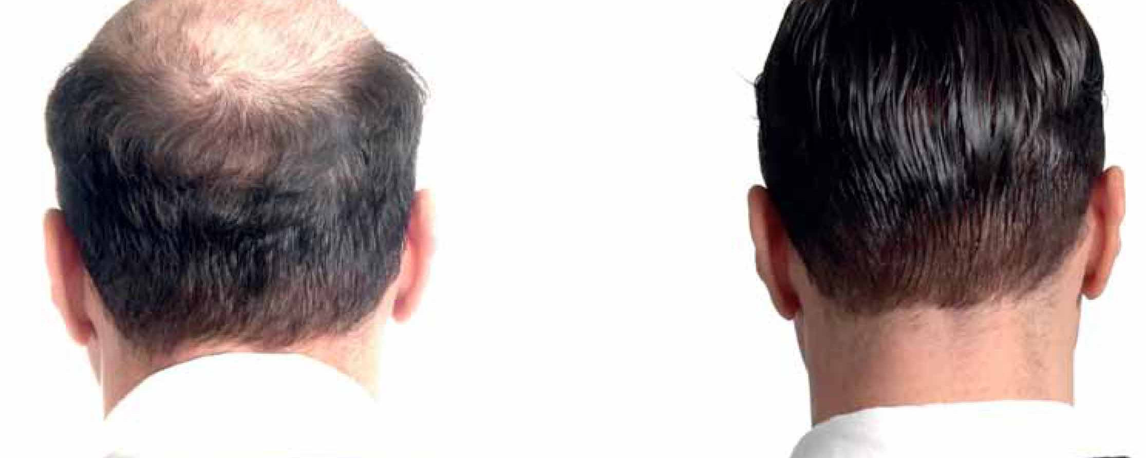 Due uomini ripresi di spalle a confronto: capelli radi e capelli folti