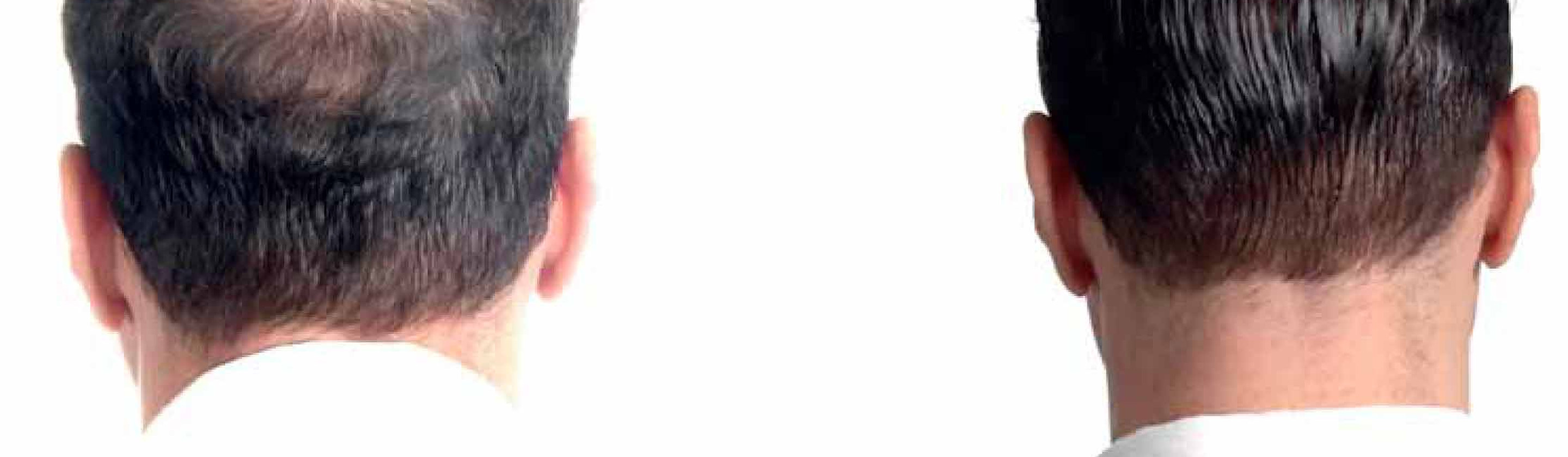 Due uomini ripresi di spalle a confronto: capelli radi e capelli folti